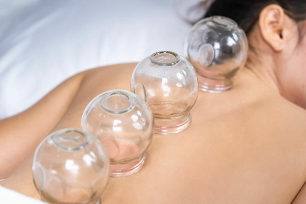 woman receiving cupping treatment